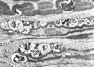 F, 8y. | metachromatic leukodystrophy … n. suralis F, 8y. | metachromatic leukodystrophy … n. suralis